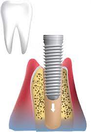 Dental Implant Surgery preston