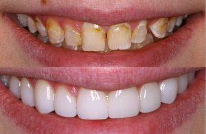 Veneers preston