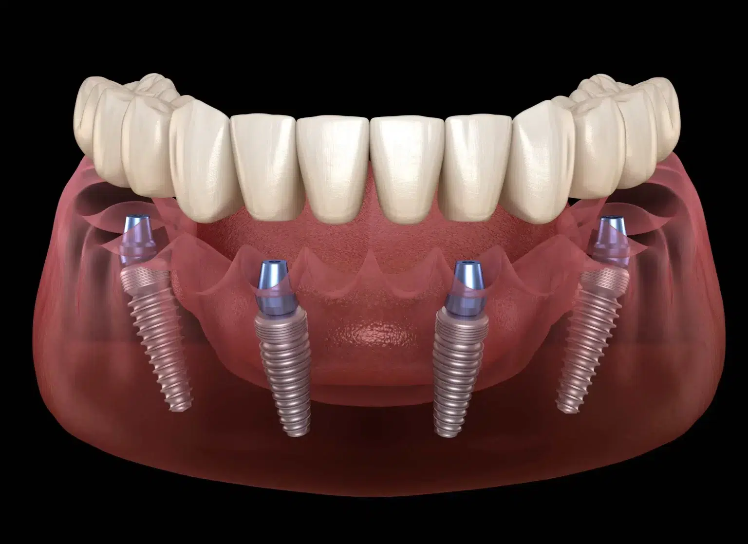 all on dental implants clinic preston