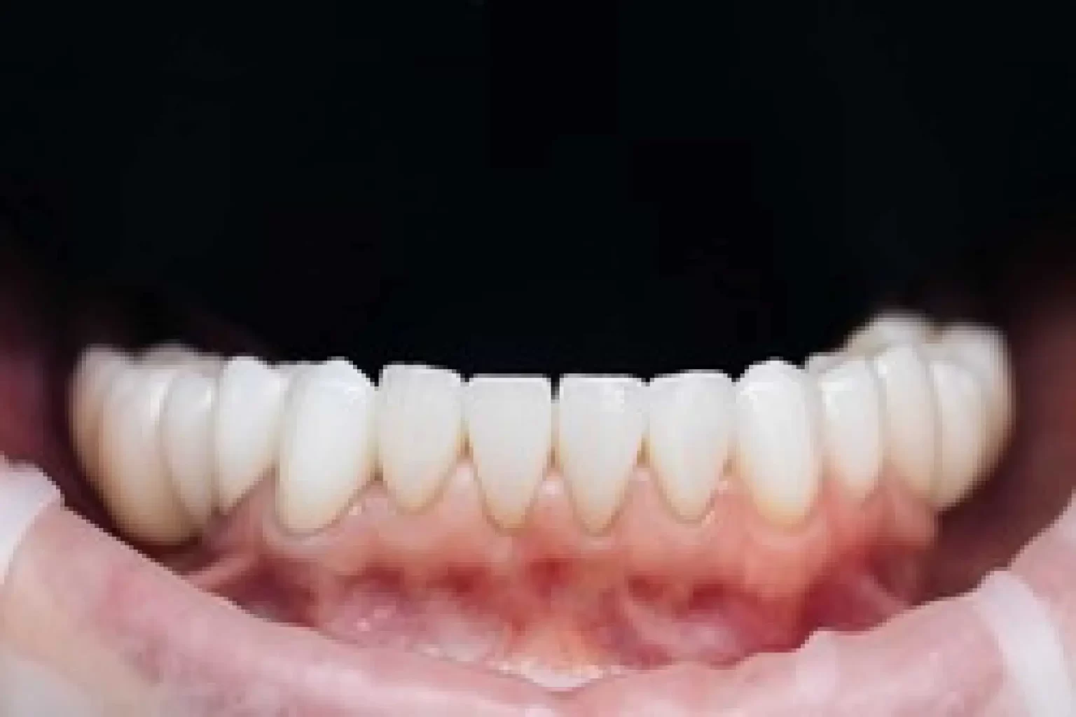 Composite Veneers Cost