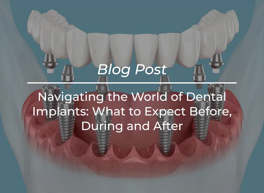 Navigating the World of Dental Implants What to Expect Before, During, and After