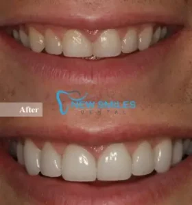 Porcelain Veneers