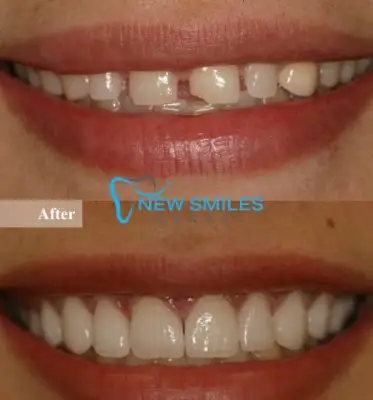 Porcelain Veneers