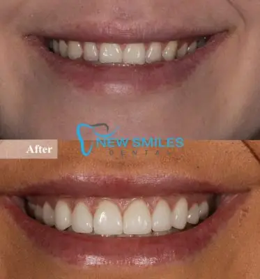 Teeth Whitening