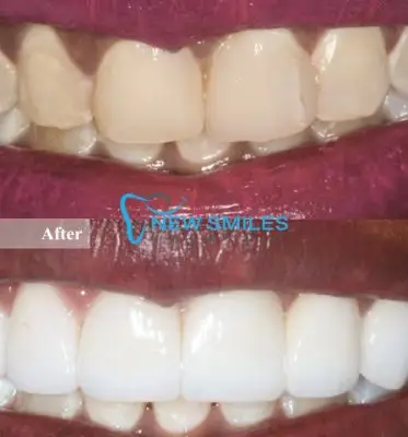 Teeth Whitening