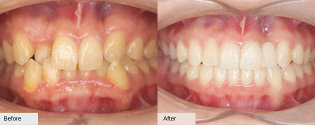 A Crossbite Before And After