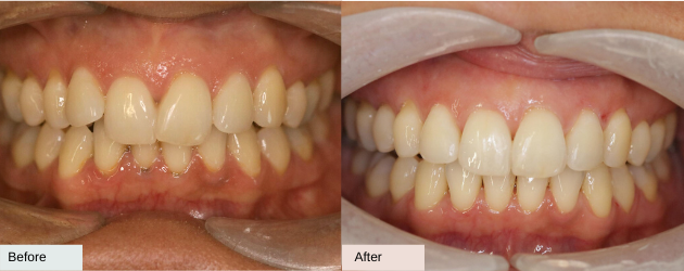 An Overbite Before And After