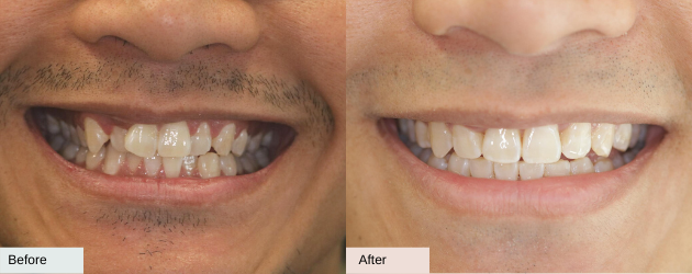 An Overly Crowded Teeth Before And After
