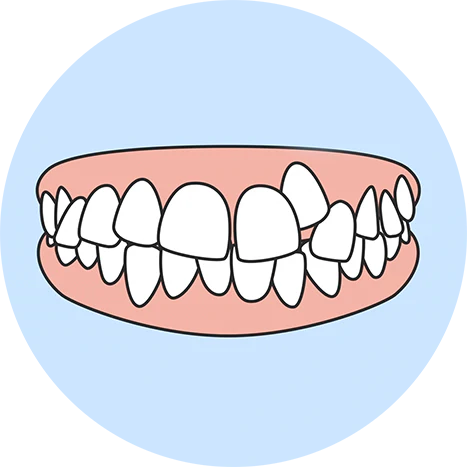 Crooked Teeth