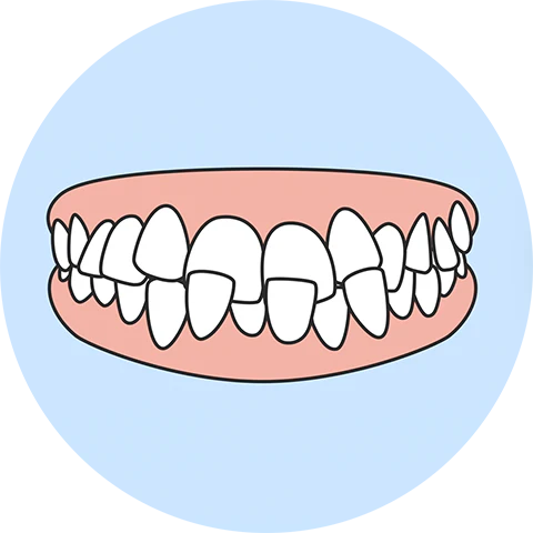 Crossbite