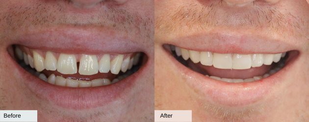 Gapped Teeth Before And After