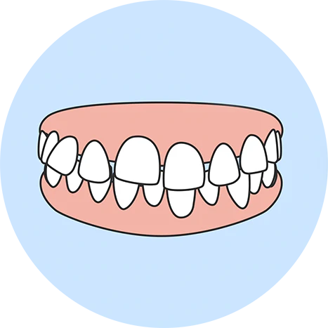 Gaps Betwween Teeth