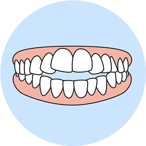 Open Bite