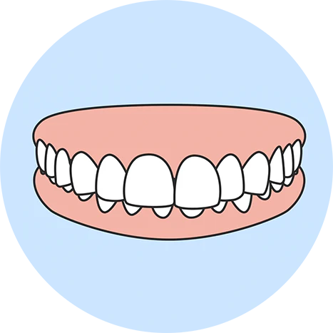 Overbite