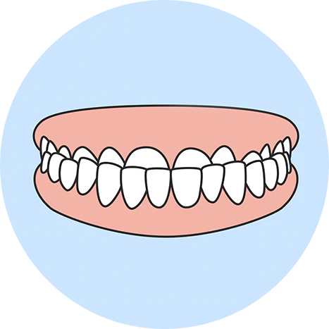 Underbite