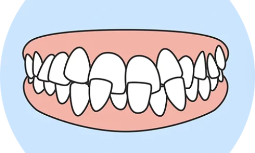 Crossbite