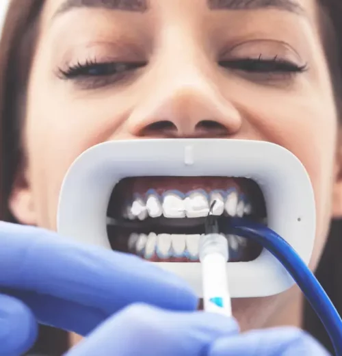 Procedural Aspects of In Chair Teeth Whitening