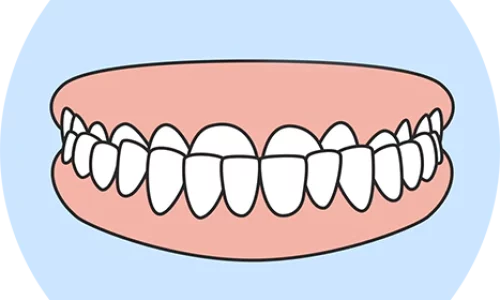 Underbite