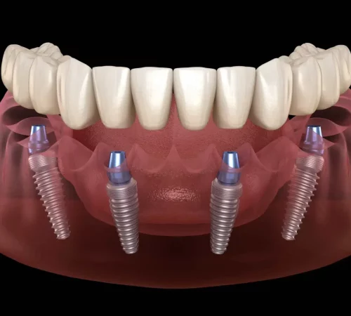 all on dental implants clinic preston