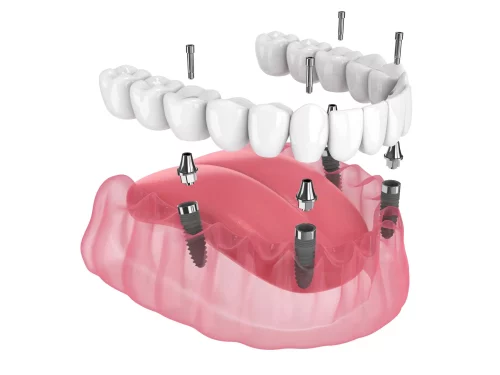 all on dental implants preston