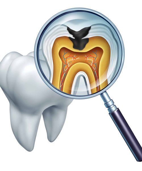 tooth decay scaled