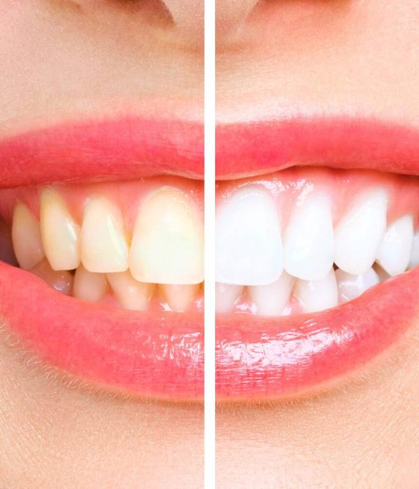 woman teeth before after whitening